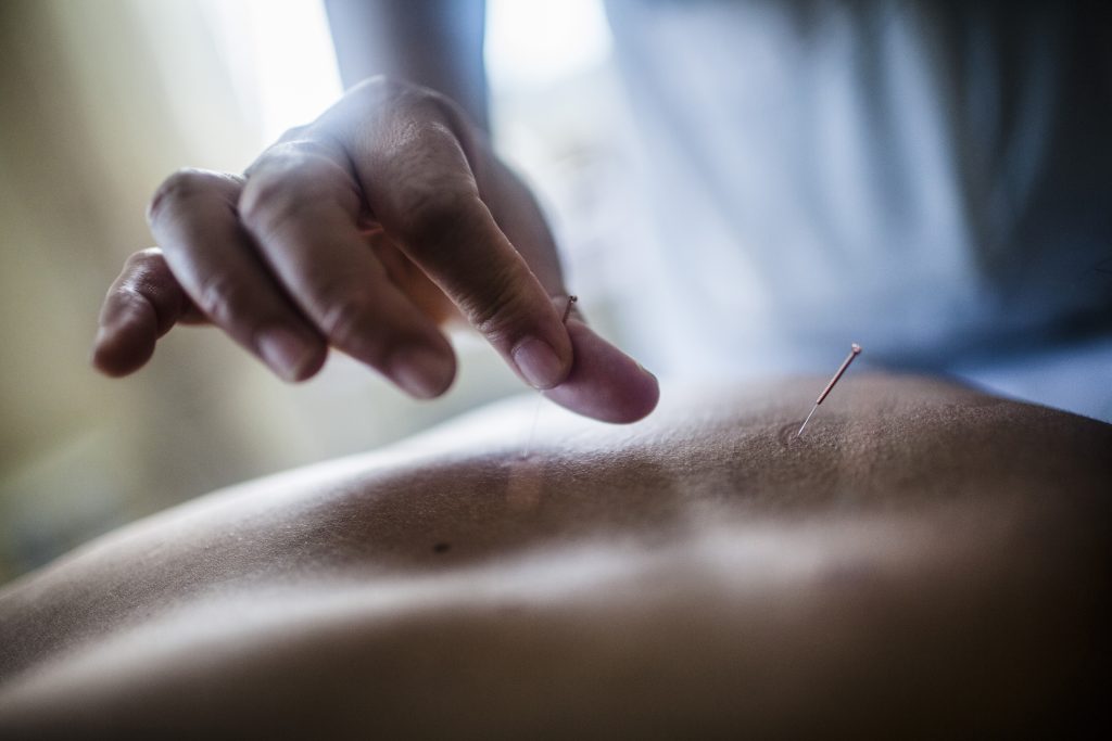 Dry Needling and Acupuncture